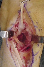Operacja zwyrodnienia stawu nadgarstkowośródręcznego kciuka