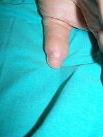 Oskalpowany kciuk - przed operacją