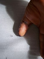 Oskalpowany kciuk - po operacji
