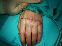 Ręka w r.z.s - po operacji