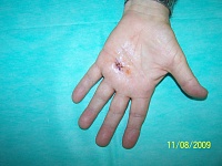 Ręka po operacji strzelającego palca