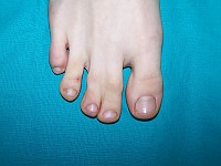 Syndaktylia stopy - przed operacją