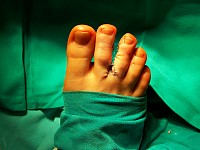 Syndaktylia stopy - po operacji